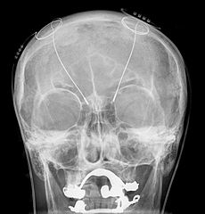 x-ray of a head